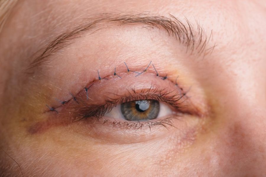 peelings for scars