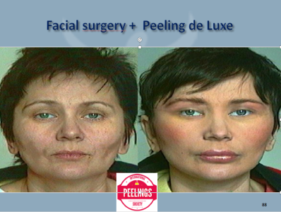 peels post surgery