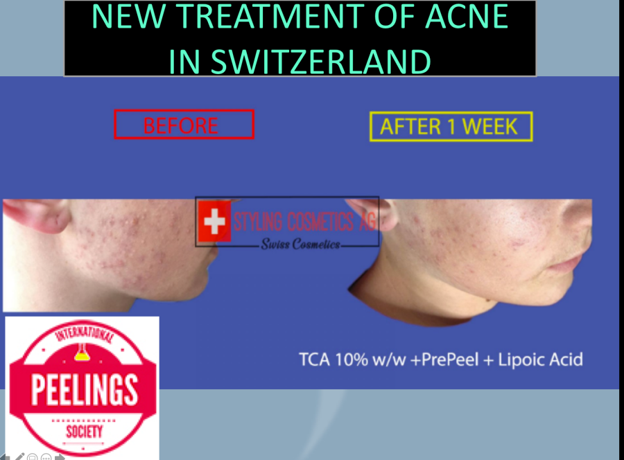 acne peeling