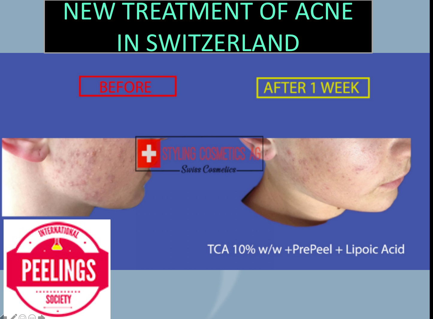 new acne treatment