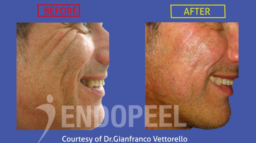 acne scars and endopeel