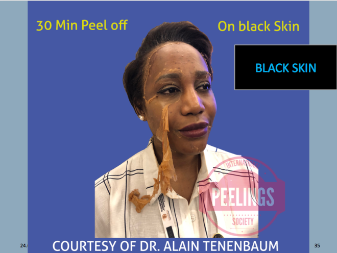 peel for black skin