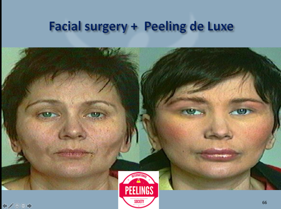 plastische Gesichtschirurgie und Peeling